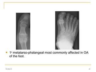    1st metatarso-phalangeal most commonly affected in OA
    of the foot.


03/08/13                                                    21
 