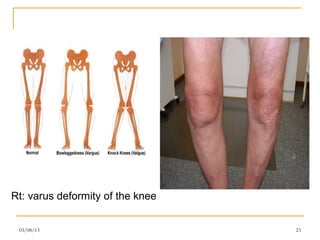 Rt: varus deformity of the knee


 03/08/13                         23
 