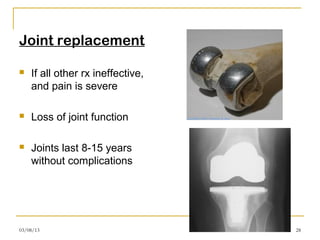 Joint replacement

   If all other rx ineffective,
    and pain is severe

   Loss of joint function

   Joints last 8-15 years
    without complications




03/08/13                           28
 