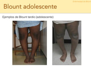 Blount adolescente
Ejemplos de Blount tardío (adolescente)
Enfermedad de Blount
 