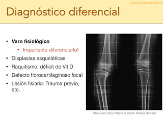 Diagnóstico diferencial
!
• Varo ﬁsiológico
• Importante diferenciarlo!
• Displasias esqueléticas
• Raquitismo, déﬁcit de Vit D
• Defecto ﬁbrocartilaginoso focal
• Lesión ﬁsiaria: Trauma previo,
etc.
Enfermedad de Blount
Tibia vara secundaria a lesión ﬁsiaria medial
 