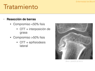 Tratamiento
• Resección de barras!
• Compromiso <50% ﬁsis
• OTT + interposición de
grasa
• Compromiso >50% ﬁsis
• OTT + epiﬁsiodesis
lateral
Enfermedad de Blount
Birch. JAAOS Jul 2013
 