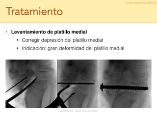 Tratamiento
• Levantamiento de platillo medial!
• Corregir depresión del platillo medial
• Indicación: gran deformidad del platillo medial
Enfermedad de Blount
Sabharwal. JBJS Am Jul 2009
 