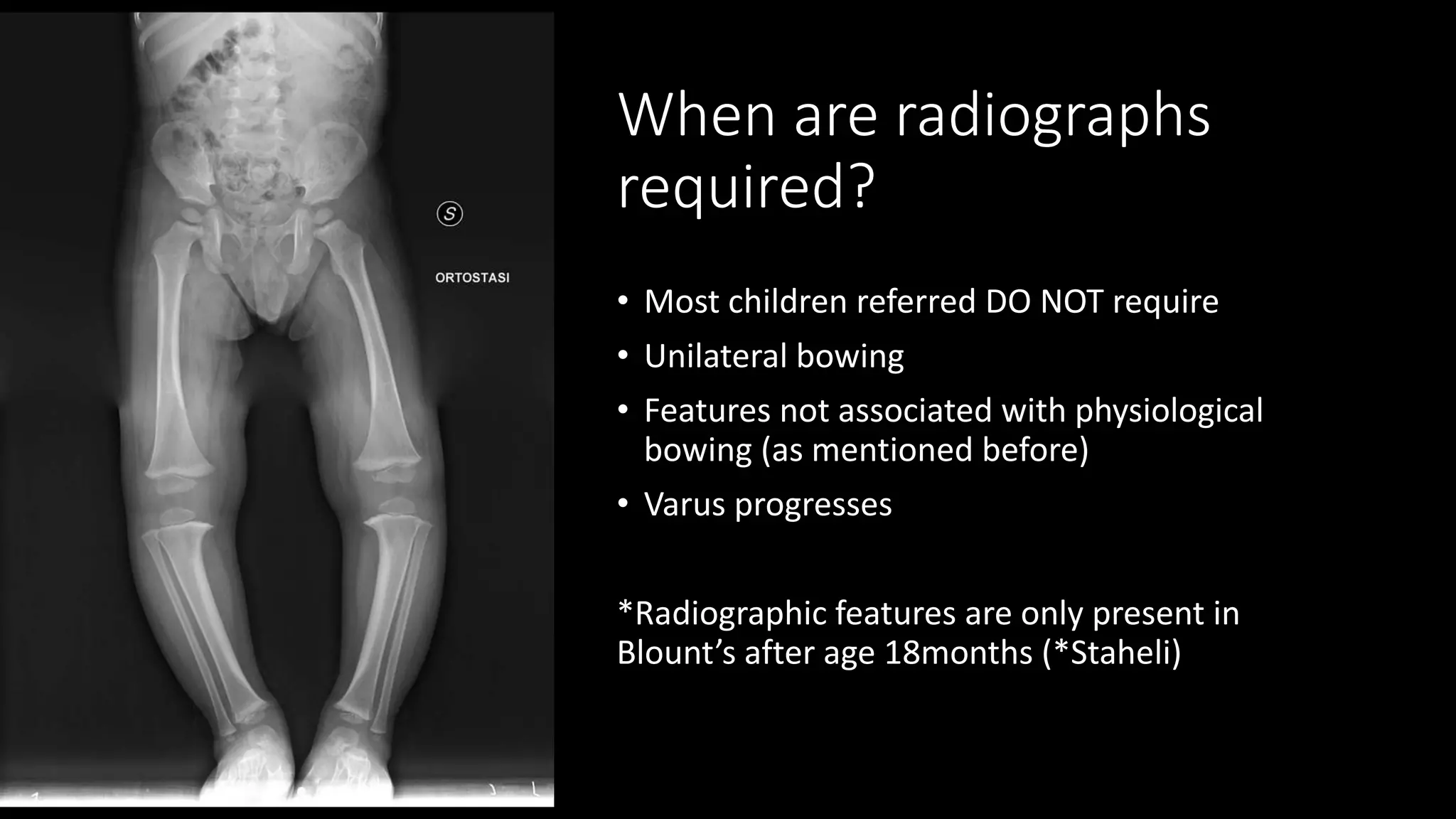blount disease pptx | PPT