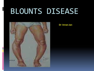 BLOUNTS DISEASE
Dr Imran Jan
 