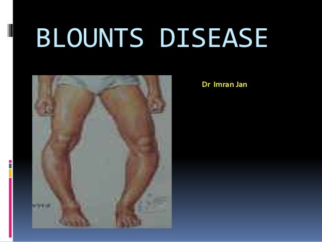 Blounts disease