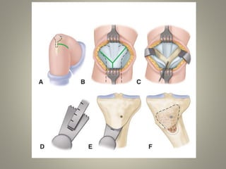 CHEVERON OSTEOTOMY
• GREENE
• MODIFICATION OF DOME OSTEOTOMY
• Advantages
 Greater Stability
 Mininmal changes in leg le...