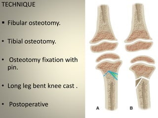 HEMICONDYLAR OSTEOTOMY
• ZAYER
INDICATED –
LIGAMENTOUS LAXITY
EXTREME DEPRESSION
AND SLOPING OF
MEDIAL TIBIAL
CONDYLE.
 