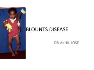 BLOUNTS DISEASE
DR AKHIL JOSE
 