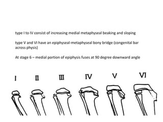 type I to IV consist of increasing medial metaphyseal beaking and sloping
type V and VI have an epiphyseal-metaphyseal bony bridge (congenital bar
across physis)
At stage 6 – medial portion of epiphysis fuses at 90 degree downward angle
 