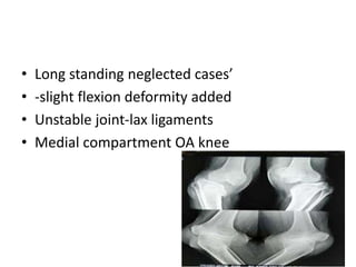• Long standing neglected cases’
• -slight flexion deformity added
• Unstable joint-lax ligaments
• Medial compartment OA knee
 