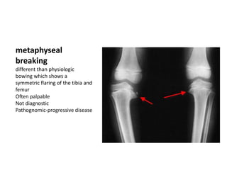 metaphyseal
breaking
different than physiologic
bowing which shows a
symmetric flaring of the tibia and
femur
Often palpable
Not diagnostic
Pathognomic-progressive disease
 