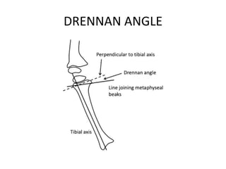 DRENNAN ANGLE
 