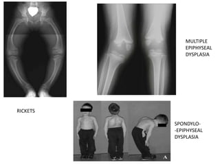 RICKETS
MULTIPLE
EPIPHYSEAL
DYSPLASIA
SPONDYLO-
-EPIPHYSEAL
DYSPLASIA
 