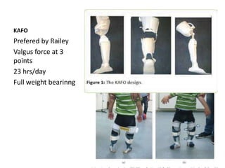 KAFO
Prefered by Railey
Valgus force at 3
points
23 hrs/day
Full weight bearinng
 