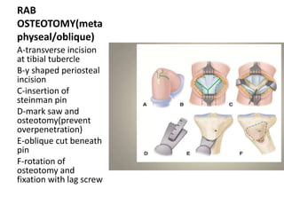 RAB
OSTEOTOMY(meta
physeal/oblique)
A-transverse incision
at tibial tubercle
B-y shaped periosteal
incision
C-insertion of
steinman pin
D-mark saw and
osteotomy(prevent
overpenetration)
E-oblique cut beneath
pin
F-rotation of
osteotomy and
fixation with lag screw
 