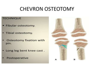 CHEVRON OSTEOTOMY
 
