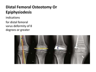 Distal Femoral Osteotomy Or
Epiphysiodesis
indications
for distal femoral
varus deformity of 8
degrees or greater
 