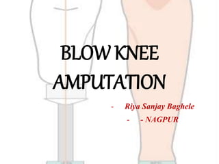 BLOW KNEE
AMPUTATION
- Riya Sanjay Baghele
- - NAGPUR
 