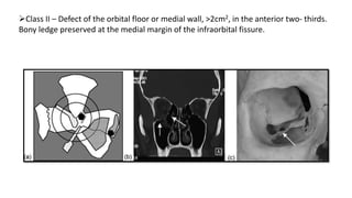 Class II – Defect of the orbital floor or medial wall, >2cm2, in the anterior two- thirds.
Bony ledge preserved at the medial margin of the infraorbital fissure.
 
