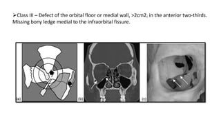 Class III – Defect of the orbital floor or medial wall, >2cm2, in the anterior two-thirds.
Missing bony ledge medial to the infraorbital fissure.
 