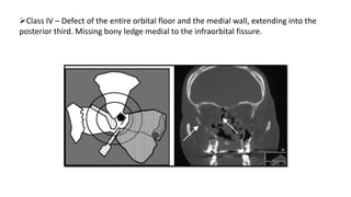 Class IV – Defect of the entire orbital floor and the medial wall, extending into the
posterior third. Missing bony ledge medial to the infraorbital fissure.
 