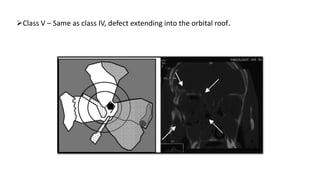 Class V – Same as class IV, defect extending into the orbital roof.
 