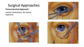 Surgical Approaches
Transconjuctival Approach:
Lateral canthotomy for lateral
exposure.
 