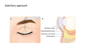 Subciliary approach
 
