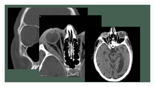 Diagnosis:
Imaging:
• Water’s view shows a convex opacity bulging into the antrum from the above.
• C.T: (coronal cut) teardrop sign, polypoid mass consists of herniated orbital contents, periorbital
fat and inferior rectus muscle. The affected sinus is partially opacified on radiograph. Air-fluid
level in maxillary sinus due to presence of blood.
• MRI: Detection of Inflammatory myopathy, Optic nerve condition, Vitreous haemorrhage.
 