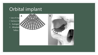 Orbital implant
• Use of implants based on degree of comminution and size of fracture
• Various implant material used
1. Autogenous bone and cartilage
2. Alloplastic material
Teflon, Marlex, polydioxanone , Etc.
 