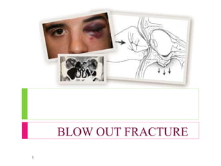 BLOW OUT FRACTURE
1
 