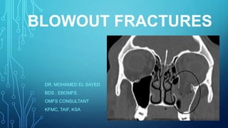 BLOWOUT FRACTURES
DR. MOHAMED EL SAYED
BDS , EBOMFS
OMFS CONSULTANT
KFMC, TAIF, KSA
 