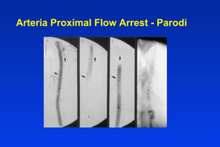 Arteria Proximal Flow Arrest - Parodi
 