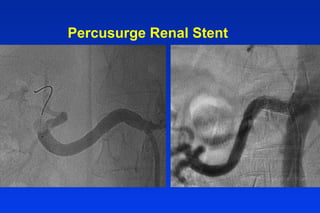 Percusurge Renal Stent
 