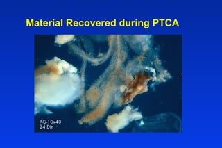 Material Recovered during PTCA
 