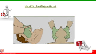 © Ramaiah University of Applied Sciences
13
Faculty of Pharmacy©M. S. Ramaiah University of Applied Sciences
13
Headtilt,chinlift+jaw thrust
 