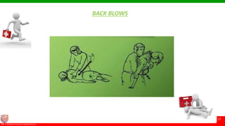 © Ramaiah University of Applied Sciences
17
Faculty of Pharmacy©M. S. Ramaiah University of Applied Sciences
17
BACK BLOWS
 