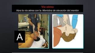 A
Vía aérea
Abra la vía aérea con la Maniobra de elevación del mentón
 