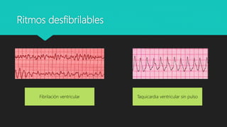Ritmos desfibrilables
Fibrilación ventricular Taquicardia ventricular sin pulso
 