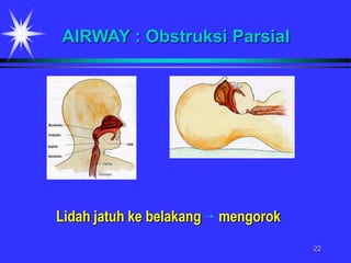22
Lidah jatuh ke belakang mengorok
AIRWAY : Obstruksi Parsial
 