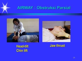 23
AIRWAY : Obstruksi Parsial
Head-tilt
Chin lift
Jaw thrust
 