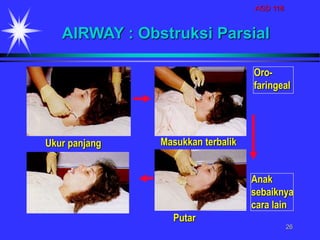 AGD 118
26
AIRWAY : Obstruksi Parsial
Ukur panjang Masukkan terbalik
Putar
Anak
sebaiknya
cara lain
Oro-
faringeal
 