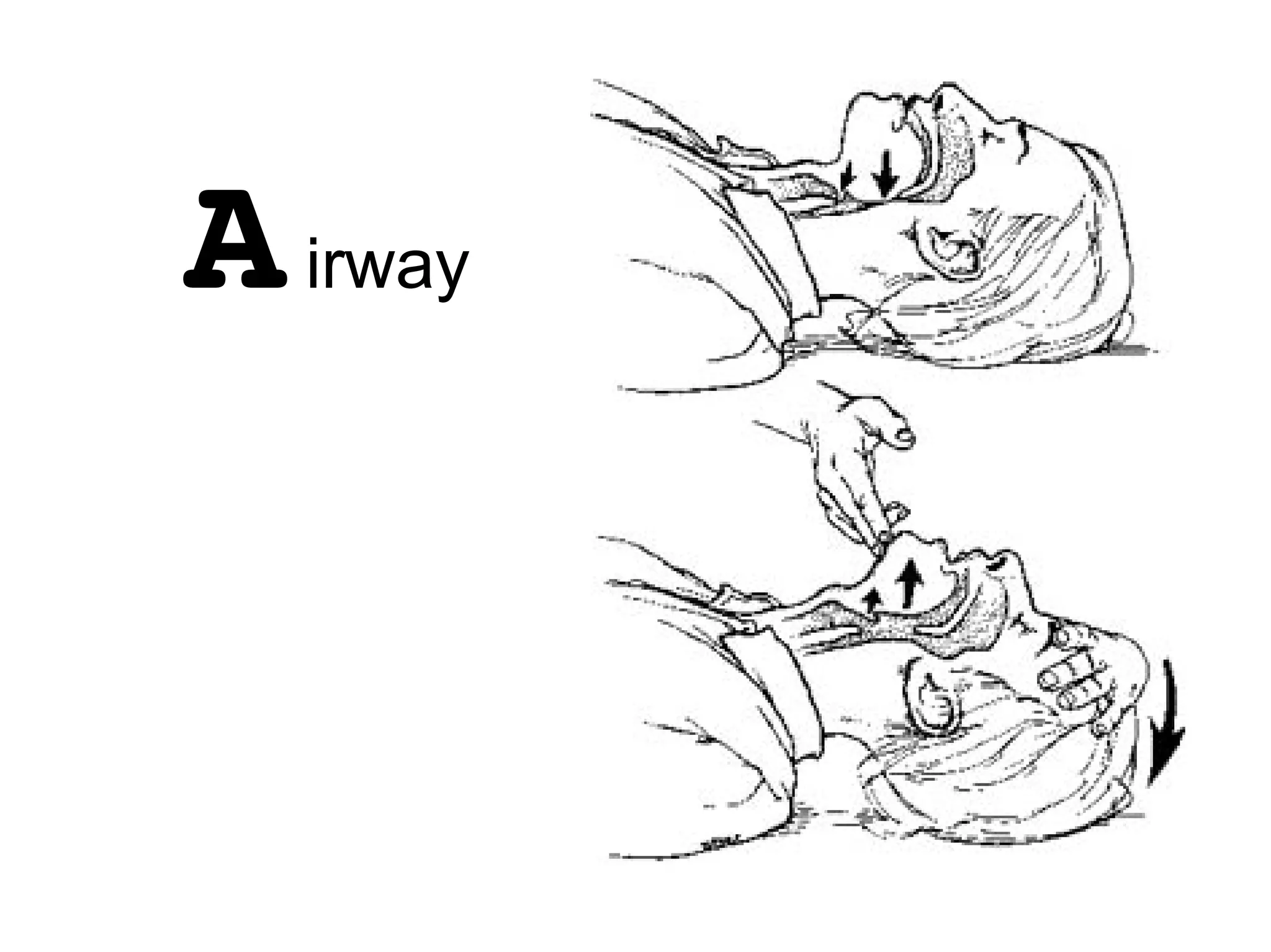 Airway