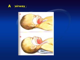A   (airway)
 