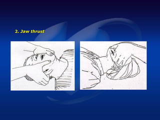2. Jaw thrust
 