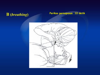 Periksa pernapasan 10 detik
B (breathing)
 