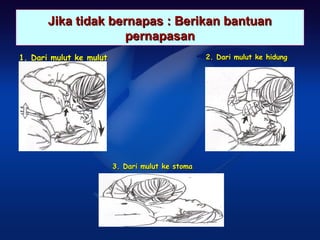 Jika tidak bernapas : Berikan bantuan
                     pernapasan
1. Dari mulut ke mulut                            2. Dari mulut ke hidung




                         3. Dari mulut ke stoma
 