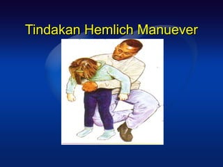 Tindakan Hemlich Manuever
 