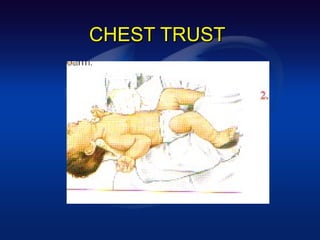 CHEST TRUST
 